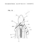 IMPLANT OVERDENTURE SYSTEM AND IMPLANT diagram and image