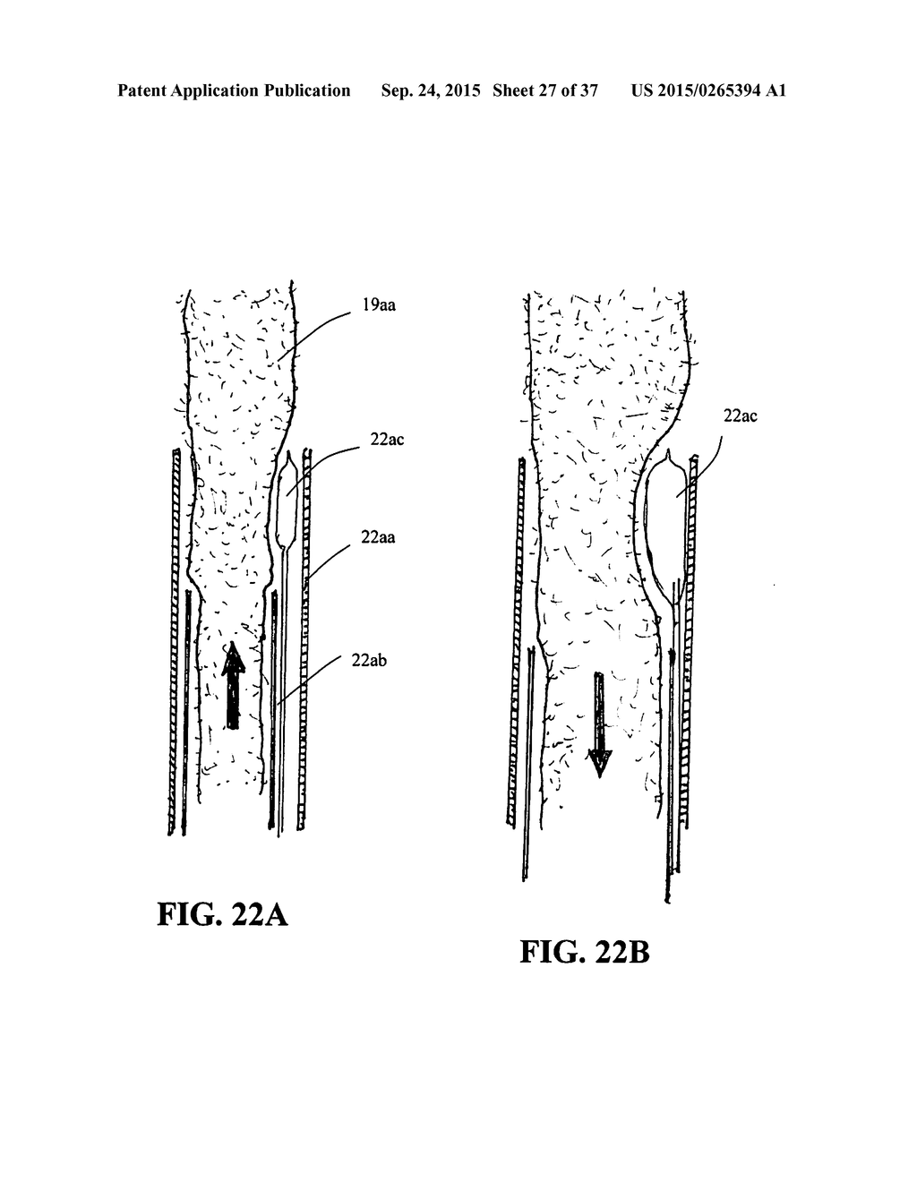 DEVICES AND METHODS FOR TREATMENT OF ABDOMINAL AORTIC ANEURYSMS - diagram, schematic, and image 28