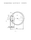 DUAL-OPTIC INTRAOCULAR LENS THAT IMPROVES OVERALL VISION WHERE THERE IS A     LOCAL LOSS OF RETINAL FUNCTION diagram and image