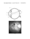 DUAL-OPTIC INTRAOCULAR LENS THAT IMPROVES OVERALL VISION WHERE THERE IS A     LOCAL LOSS OF RETINAL FUNCTION diagram and image