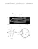 DUAL-OPTIC INTRAOCULAR LENS THAT IMPROVES OVERALL VISION WHERE THERE IS A     LOCAL LOSS OF RETINAL FUNCTION diagram and image