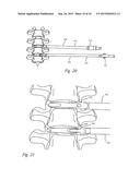 Intervertebral Implant diagram and image