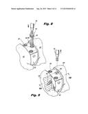 ORTHOPEDIC IMPLANTS WITH FLEXIBLE SCREWS diagram and image