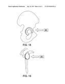 ORTHOPEDIC IMPLANTS WITH FLEXIBLE SCREWS diagram and image