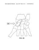 ORTHOPEDIC IMPLANTS WITH FLEXIBLE SCREWS diagram and image