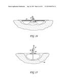 DRESSING AND APPARATUS FOR CLEANSING THE WOUNDS diagram and image