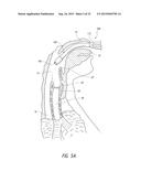 APPARATUS AND METHOD FOR IMPROVED ASSISTED VENTILATION diagram and image