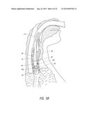 APPARATUS AND METHOD FOR IMPROVED ASSISTED VENTILATION diagram and image