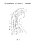 APPARATUS AND METHOD FOR IMPROVED ASSISTED VENTILATION diagram and image