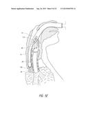 APPARATUS AND METHOD FOR IMPROVED ASSISTED VENTILATION diagram and image