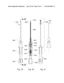 Intravenous Catheter with Pressure Activated Valve diagram and image