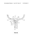 BREAK-AWAY THERMAL BLANKET JOINT diagram and image