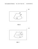 ULTRASOUND IMAGING SYSTEM AND METHOD FOR TRACKING A SPECULAR REFLECTOR diagram and image