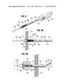 APICAL PUNCTURE ACCESS AND CLOSURE SYSTEM diagram and image