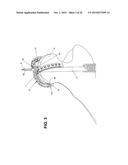 METHOD, DEVICE, AND SYSTEM FOR SHAVING AND SHAPING OF A JOINT diagram and image