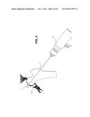 METHOD, DEVICE, AND SYSTEM FOR SHAVING AND SHAPING OF A JOINT diagram and image