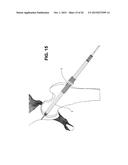 METHOD, DEVICE, AND SYSTEM FOR SHAVING AND SHAPING OF A JOINT diagram and image