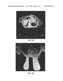 BREAST SUPPORT AND IMMOBILIZATION DEVICE FOR RADIOTHERAPY diagram and image