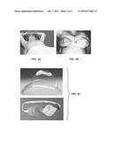 BREAST SUPPORT AND IMMOBILIZATION DEVICE FOR RADIOTHERAPY diagram and image