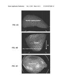 BREAST SUPPORT AND IMMOBILIZATION DEVICE FOR RADIOTHERAPY diagram and image