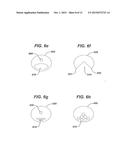 Directional Tissue Expander diagram and image