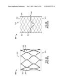 TRANSCATHETER MITRAL VALVE STENT FRAMES diagram and image