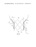 TRANSCATHETER MITRAL VALVE STENT FRAMES diagram and image