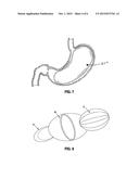 Intragastric Balloon for Treating Obesity diagram and image