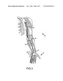 GARMENT TO FACILITATE ELECTRODE PLACEMENT FOR INTRAOPERATIVE MONITORING diagram and image