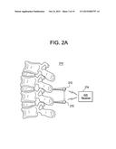 METHODS AND DEVICES FOR SPINAL CORRECTION diagram and image