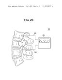 METHODS AND DEVICES FOR SPINAL CORRECTION diagram and image