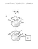 METHODS AND DEVICES FOR SPINAL CORRECTION diagram and image