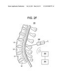 METHODS AND DEVICES FOR SPINAL CORRECTION diagram and image