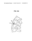 METHODS AND DEVICES FOR SPINAL CORRECTION diagram and image