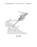 KNOTLESS ANCHOR diagram and image