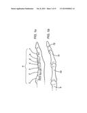 DEVICE FOR ASSISTING IN FLEXOR TENDON REPAIR AND REHABILITATION diagram and image