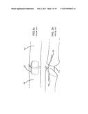 DEVICE FOR ASSISTING IN FLEXOR TENDON REPAIR AND REHABILITATION diagram and image