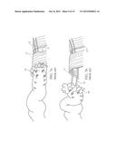 DEVICE FOR ASSISTING IN FLEXOR TENDON REPAIR AND REHABILITATION diagram and image