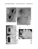 COLLECTING AND HARVESTING CUT BONE FROM KERRISON RONGEUR diagram and image