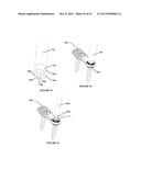 Polyaxial Plate Rod System and Surgical Procedure diagram and image