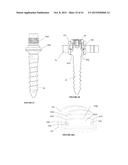 Polyaxial Plate Rod System and Surgical Procedure diagram and image