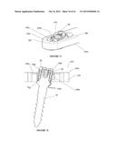 Polyaxial Plate Rod System and Surgical Procedure diagram and image