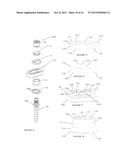 Polyaxial Plate Rod System and Surgical Procedure diagram and image