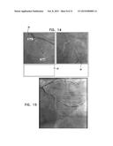 IDENTIFICATION AND PRESENTATION OF DEVICE-TO-VESSEL RELATIVE MOTION diagram and image