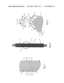 Patterned Sling Implant and Method diagram and image