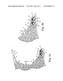 Patterned Implant and Method diagram and image