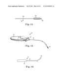 Patterned Implant and Method diagram and image