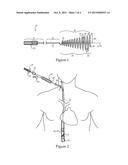 VASCULAR IMPLANT RETRIEVAL METHOD, RETRIEVAL ASSEMBLY AND TOOL FOR SAME diagram and image