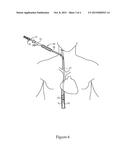 VASCULAR IMPLANT RETRIEVAL METHOD, RETRIEVAL ASSEMBLY AND TOOL FOR SAME diagram and image