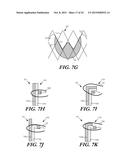 CUFF CONFIGURATIONS FOR PROSTHETIC HEART VALVE diagram and image